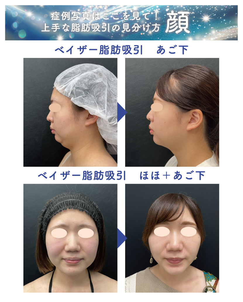 ベイザー脂肪吸引:顔