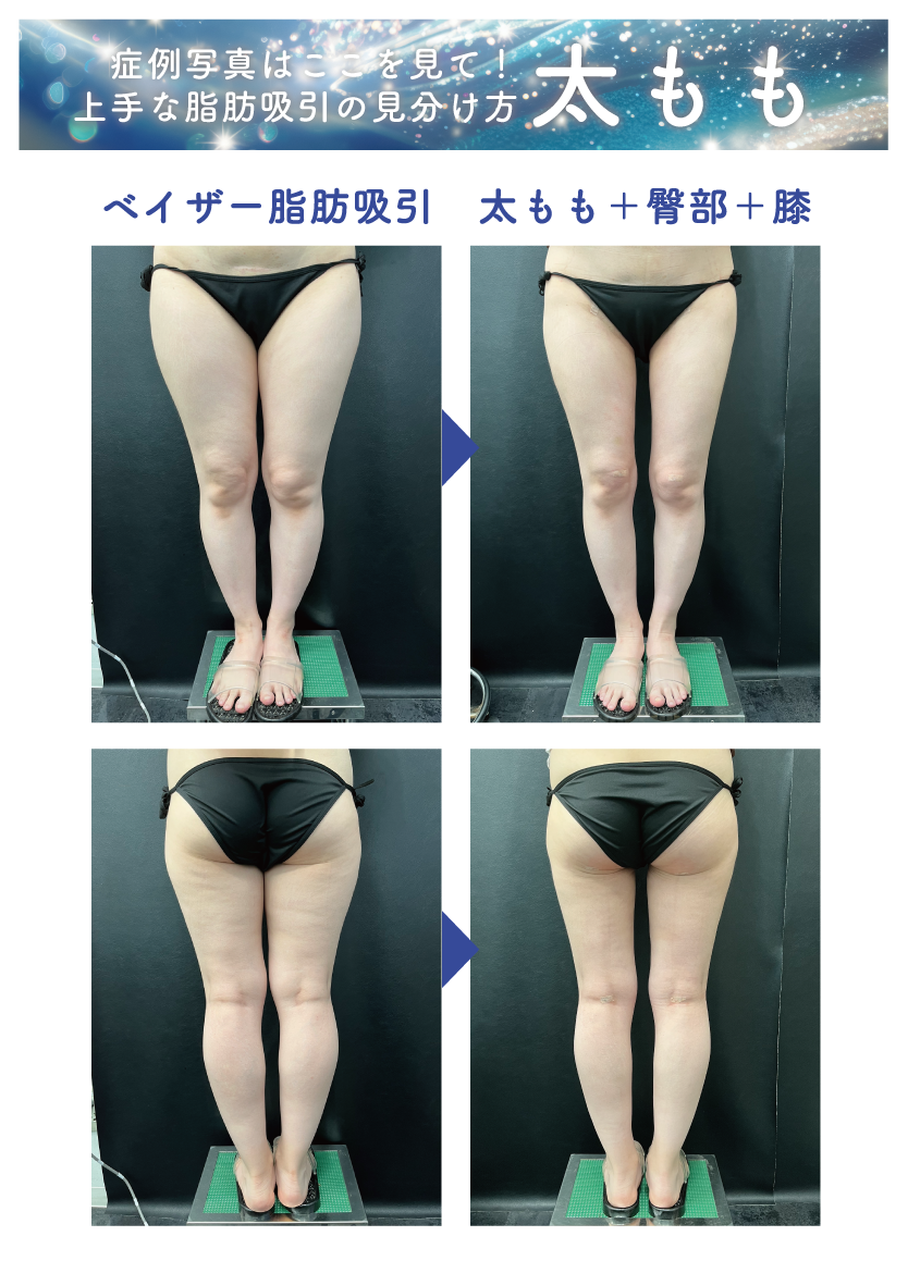 ベイザー脂肪吸引:太もも