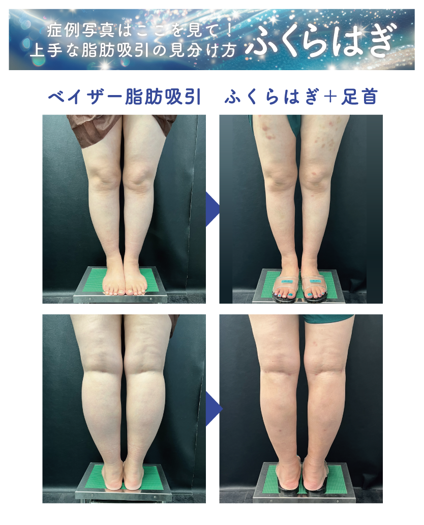ベイザー脂肪吸引:ふくらはぎ