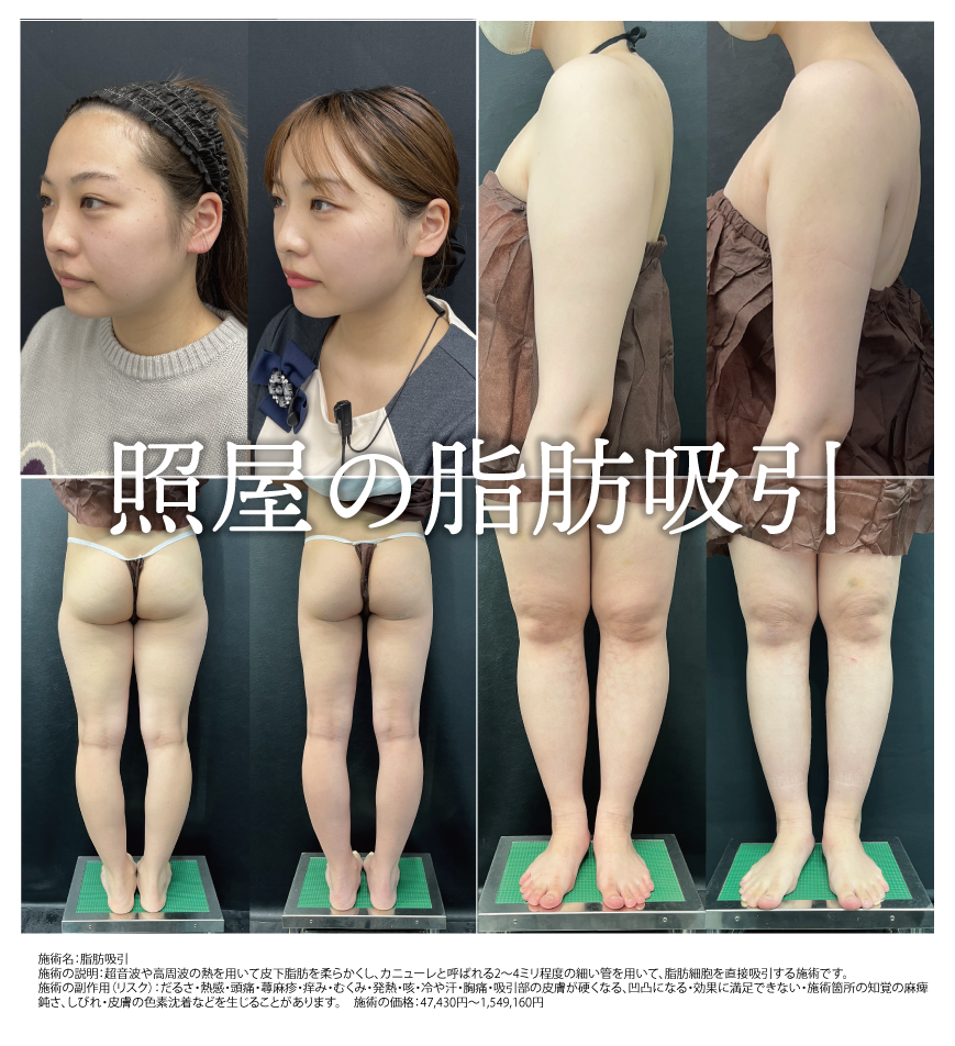 3.脂肪吸引