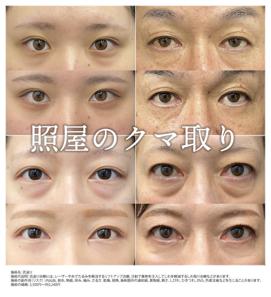1. クマ取り