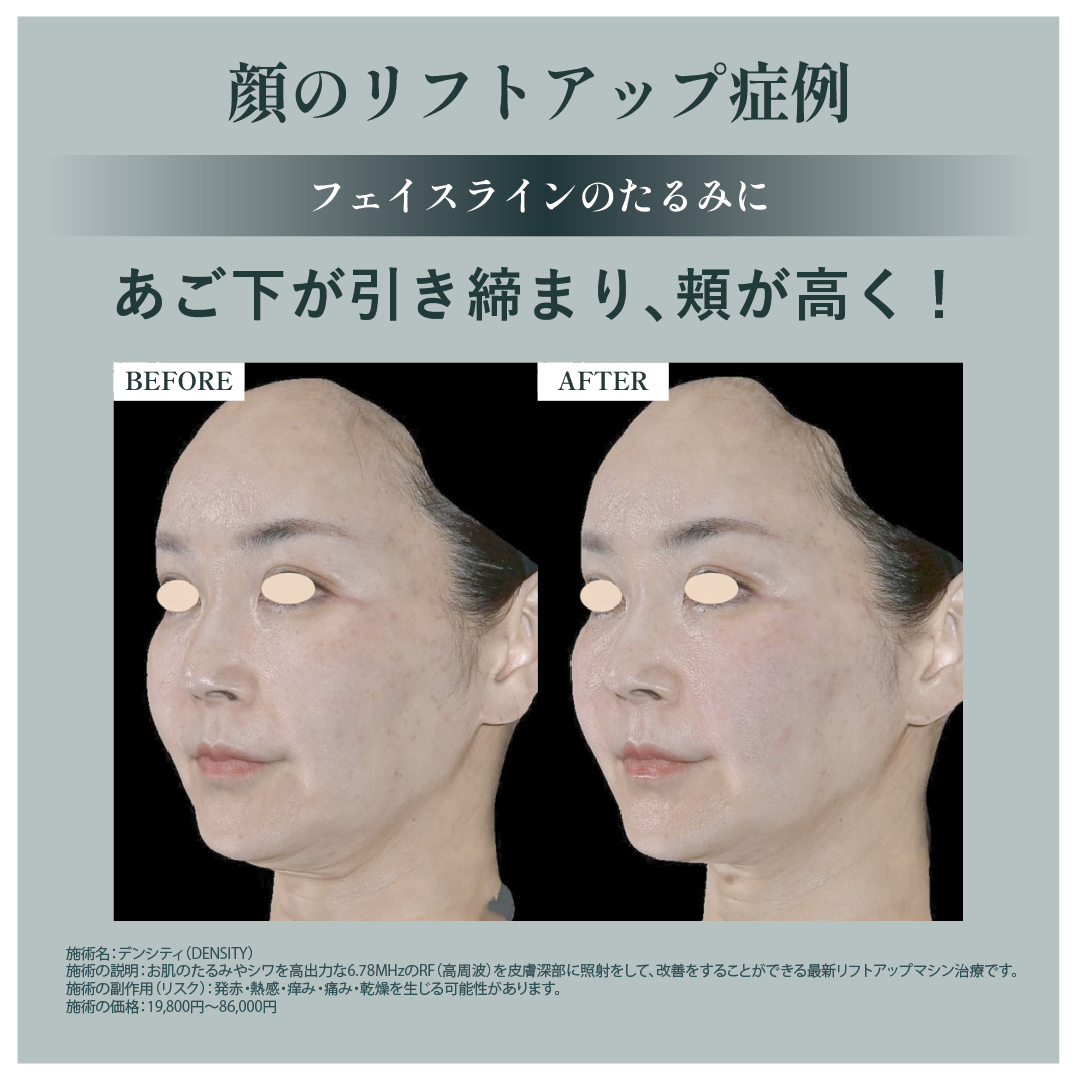お顔のリフトアップには「デンシティ」