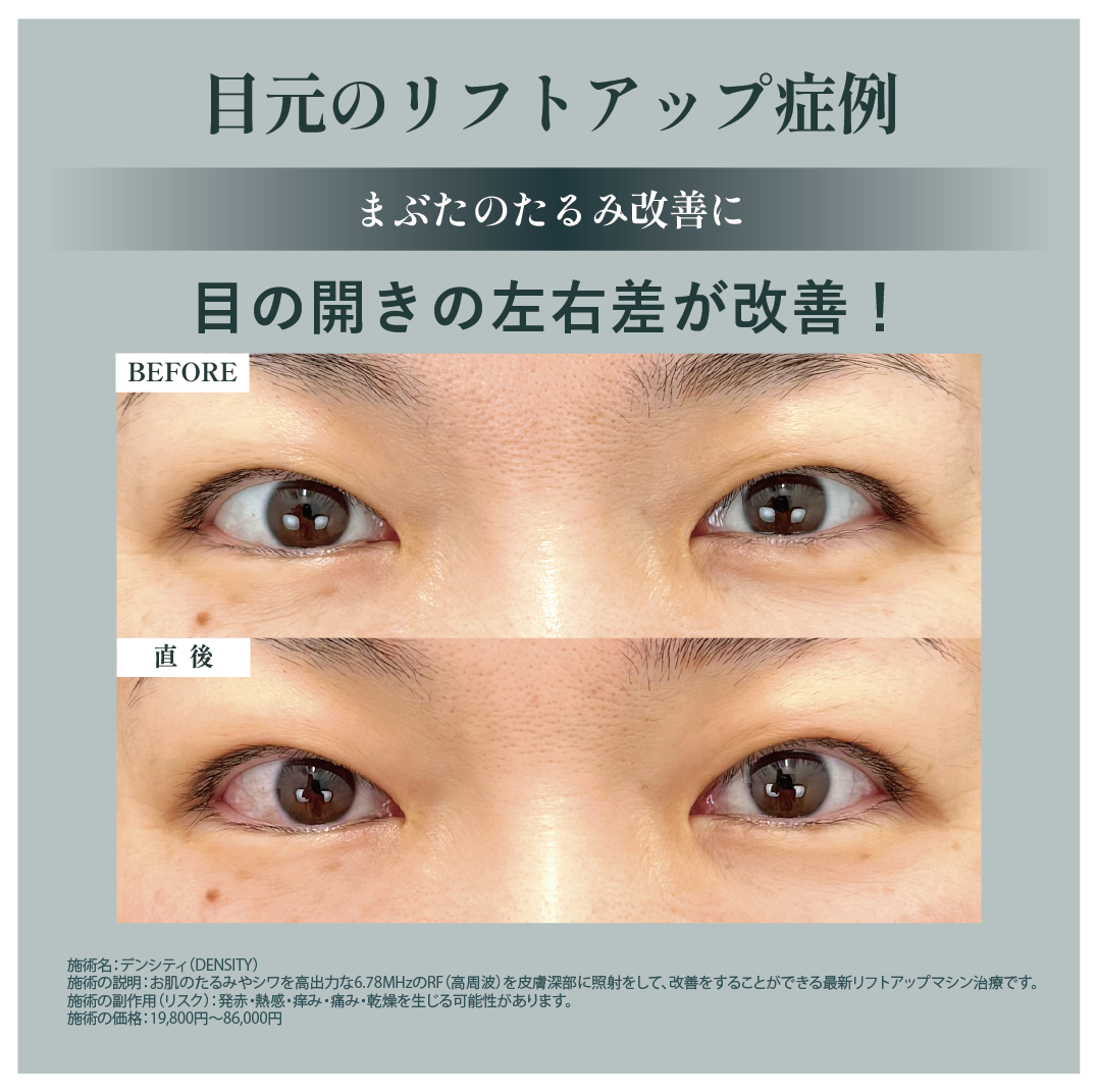 目元のたるみには「デンシティアイ」