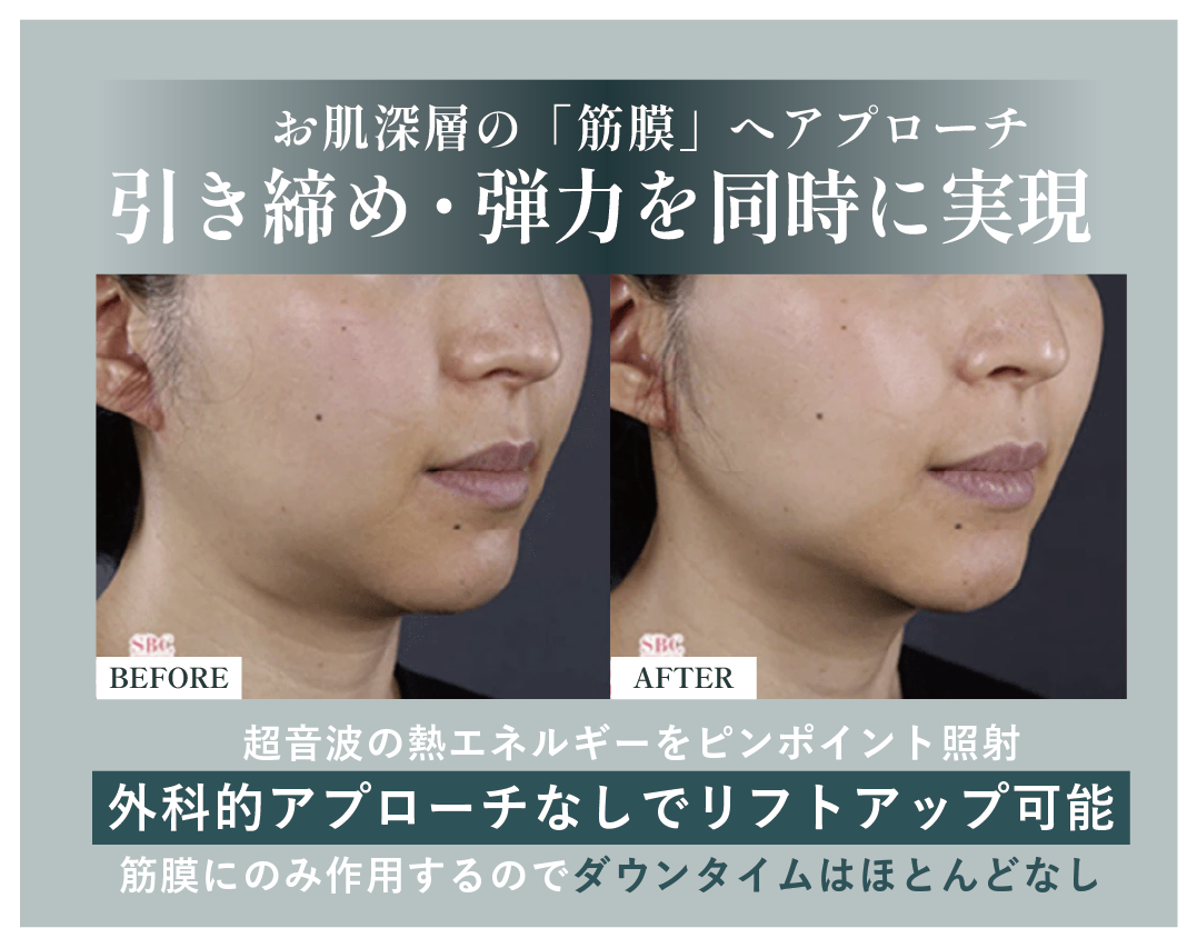 さらに奥の筋膜へのケアは「ハイフ」