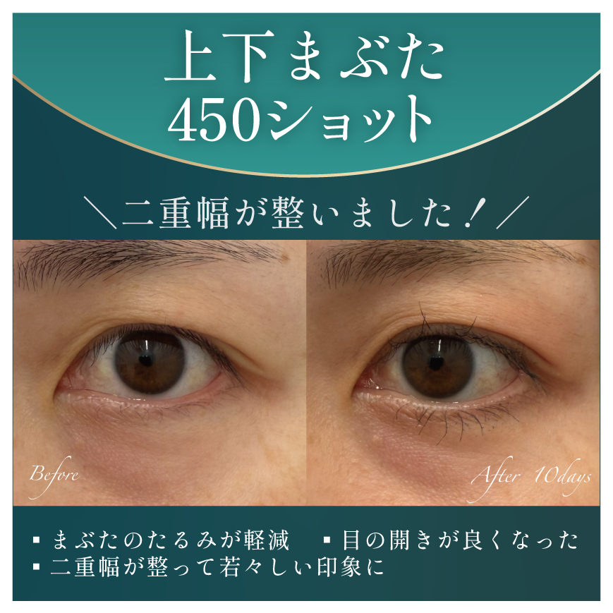 上下まぶた450ショット