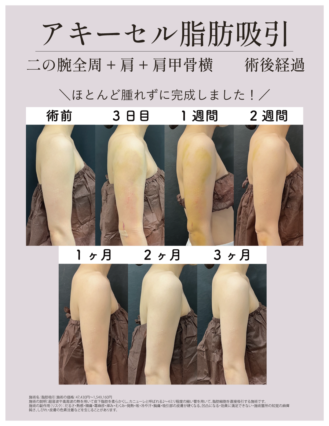 施術の早さ＝ダウンタイムの短さ
