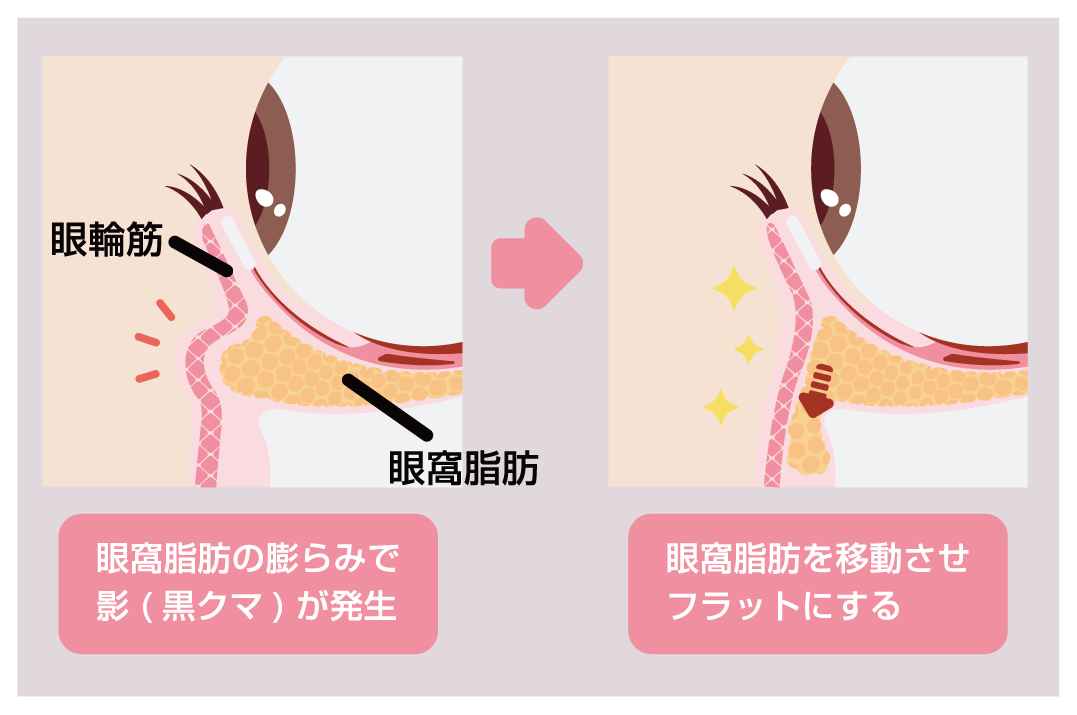 脂肪注入なしでクマ改善できる！