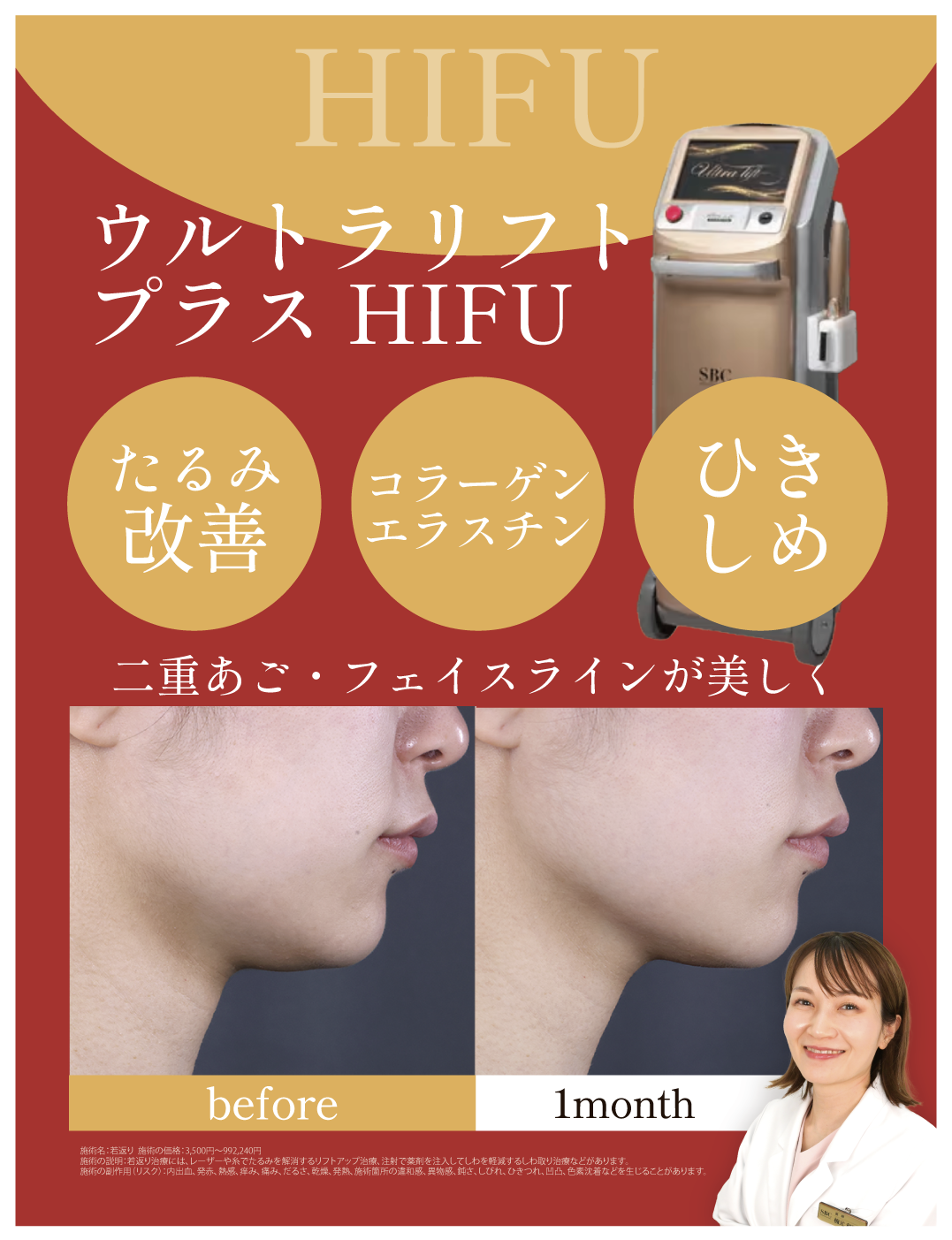 ウルトラリフトプラスHIFU