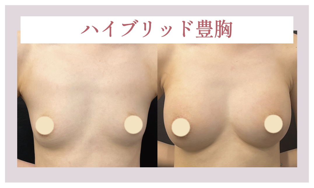 シリコンバッグ＋脂肪注入