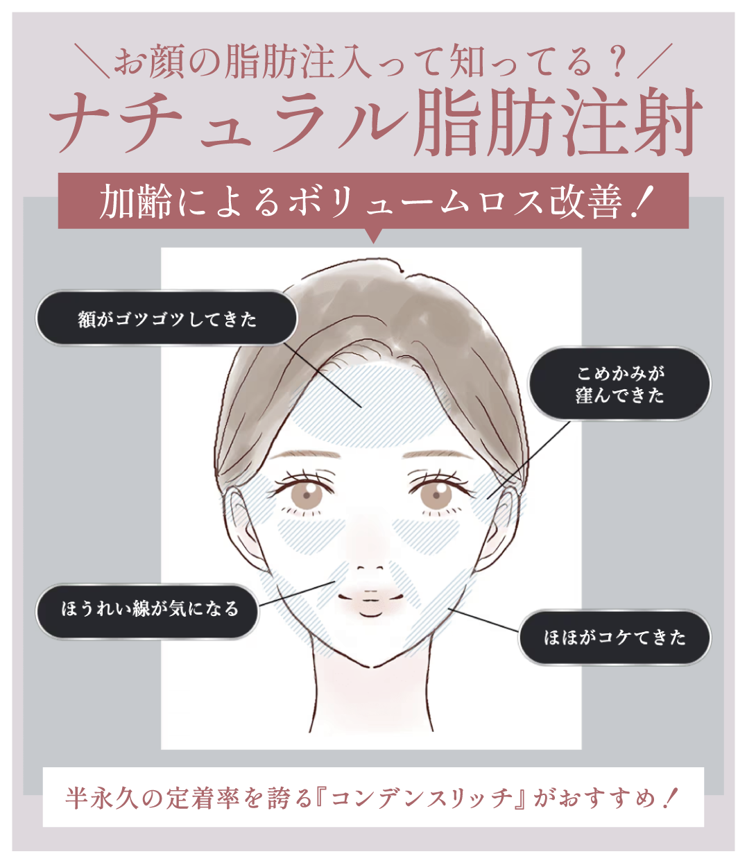 ナチュラル脂肪注射-コンデンスリッチ-