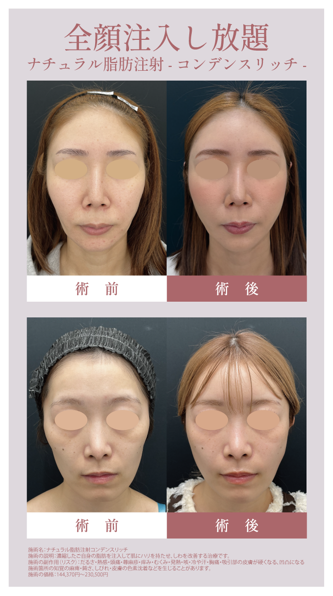 全顔脂肪注入し放題