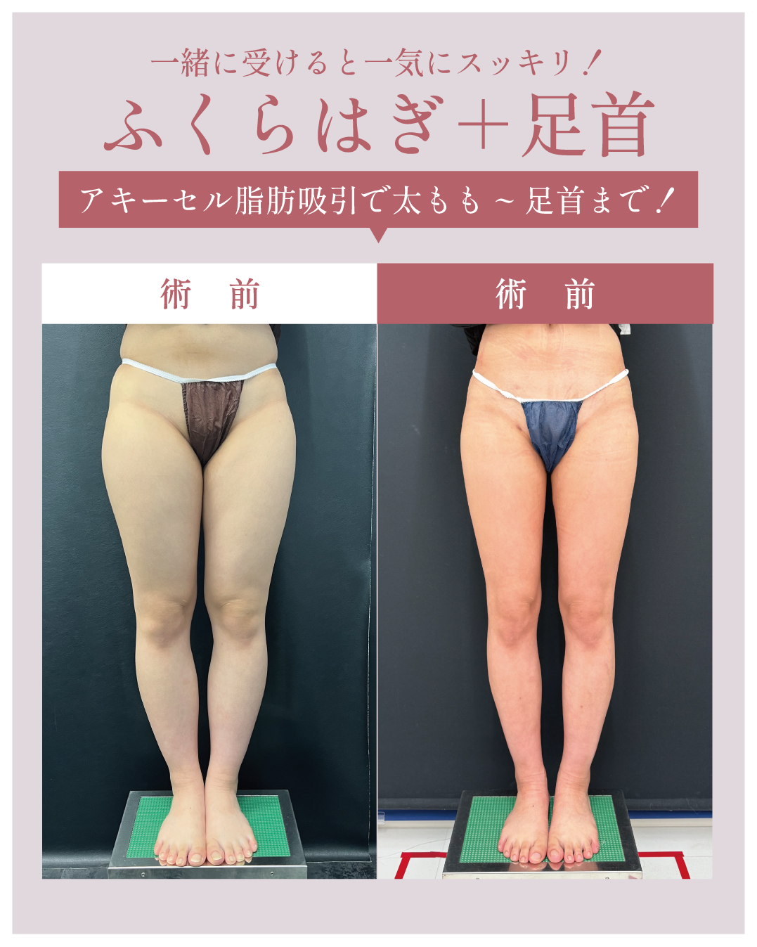 ふくらはぎ＋足首の脂肪吸引