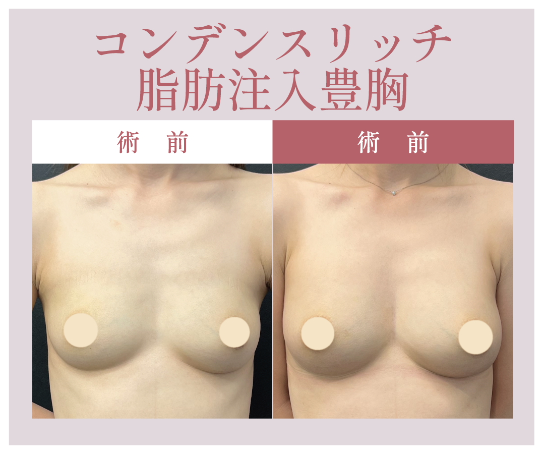 いらない脂肪をお胸にお引越し！