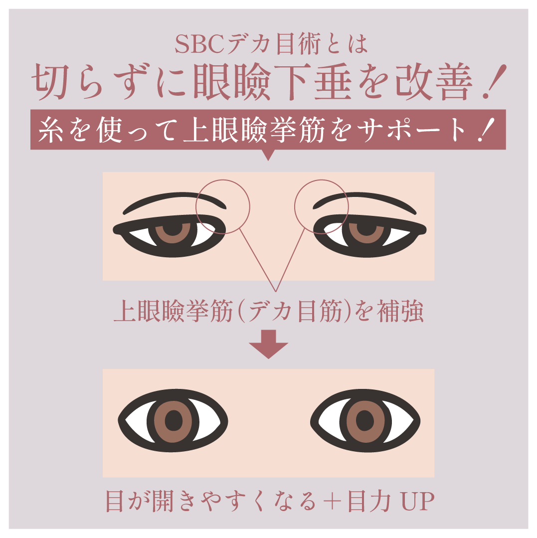 切らずに眼瞼下垂を改善！