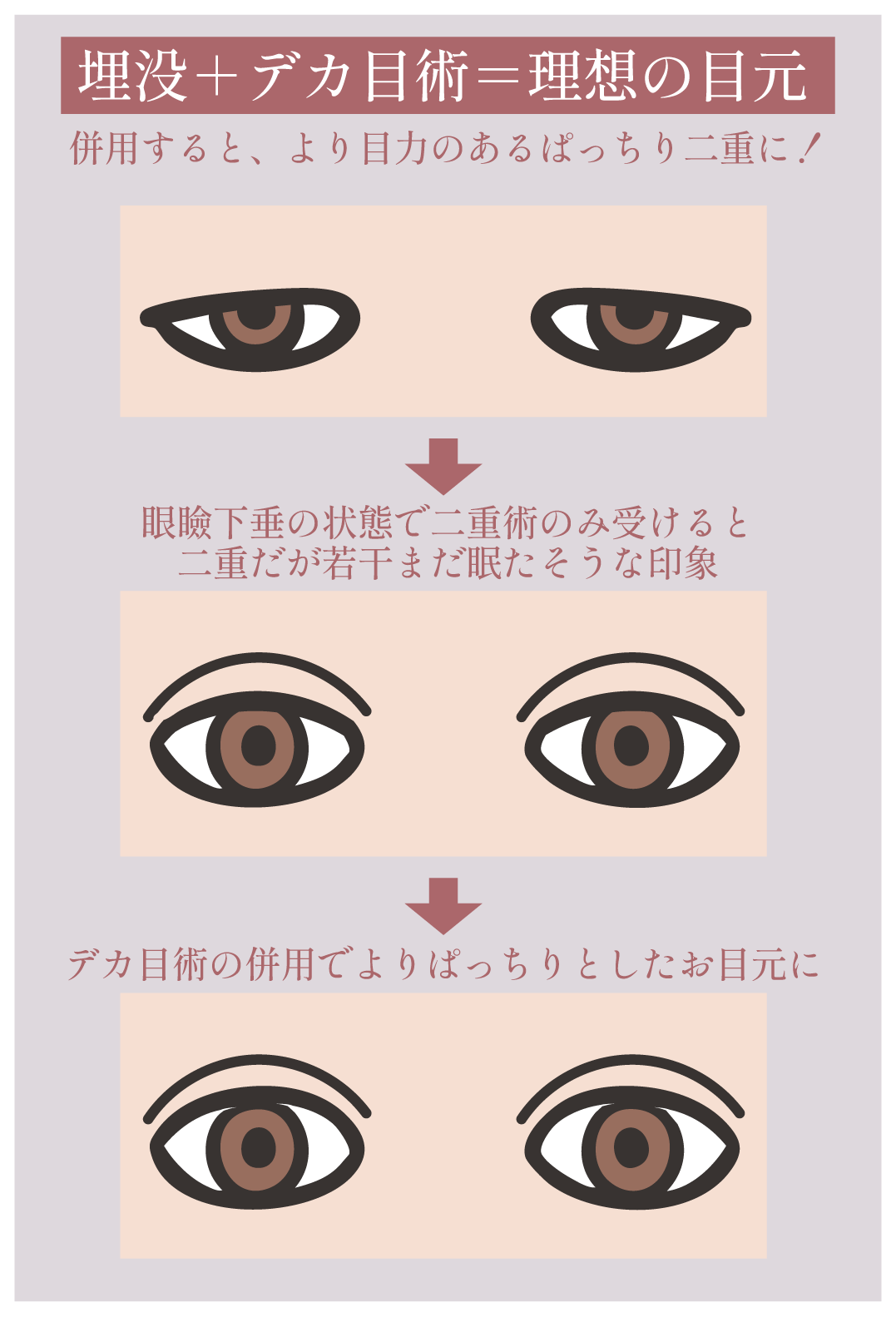 メリット③：埋没と併用で理想にグッと近づく！
