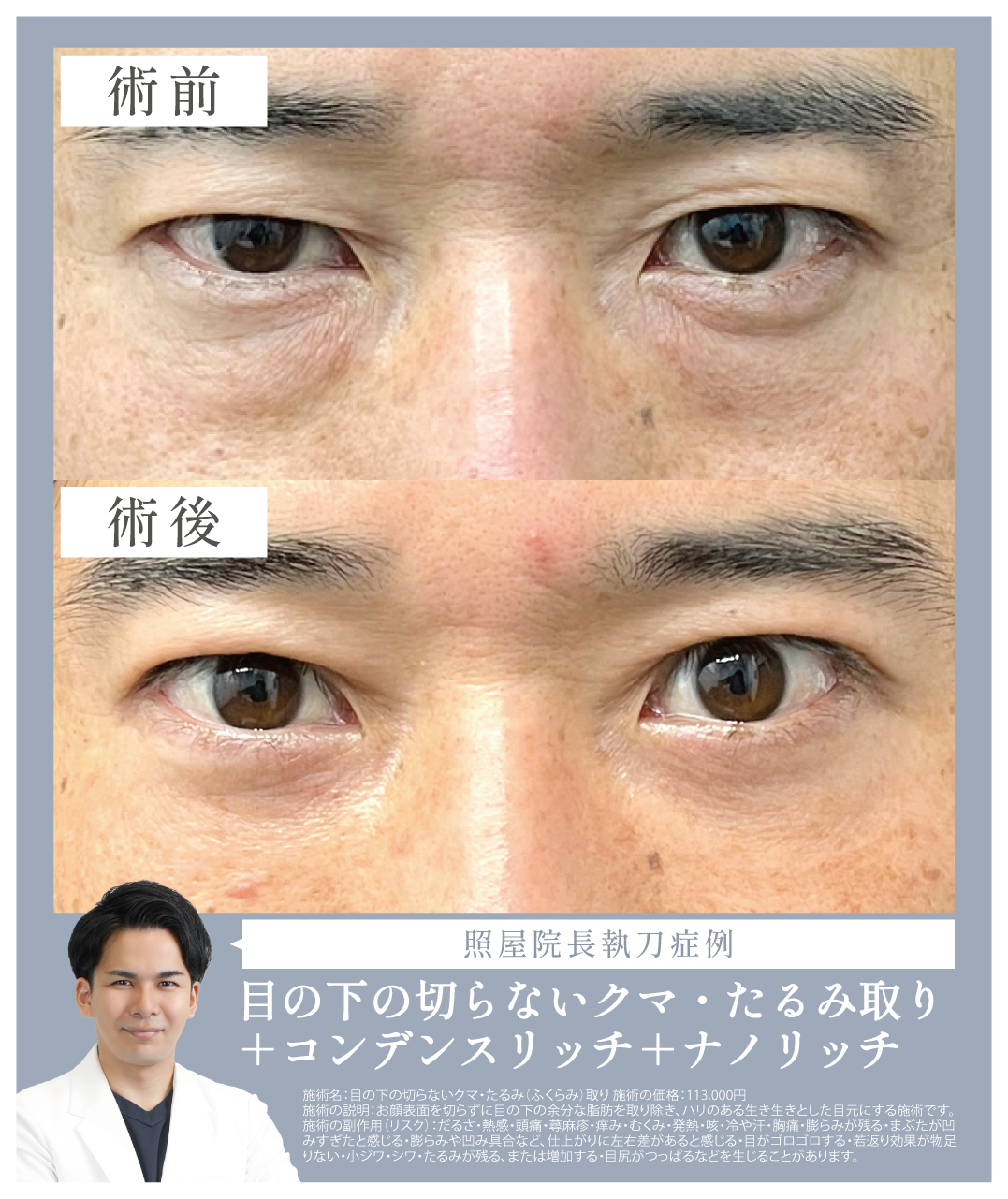 目の下の切らないクマ・たるみ取り