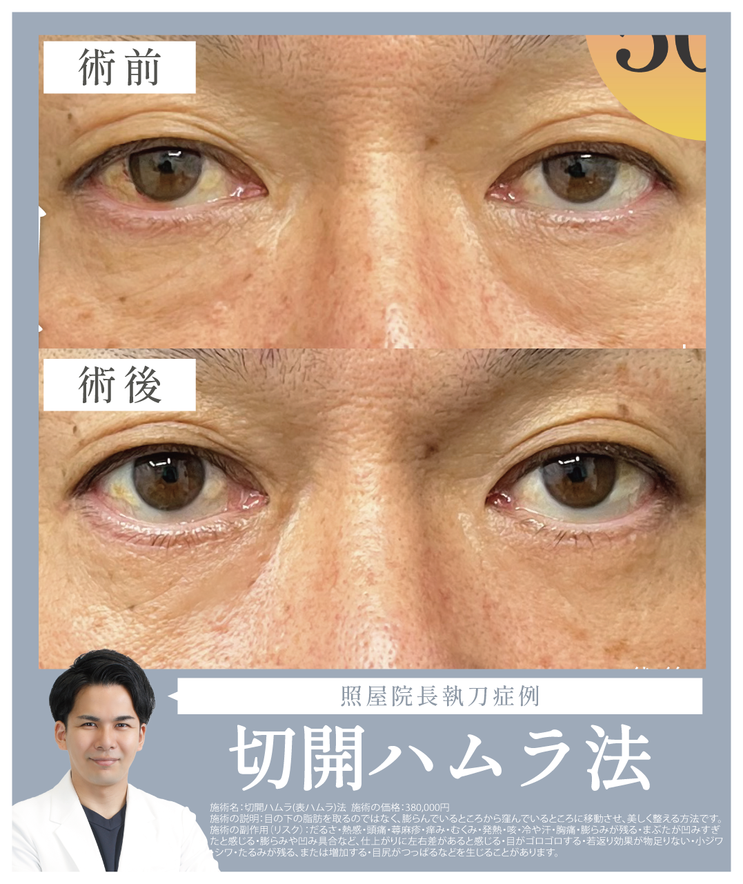 切開ハムラ（表ハムラ）