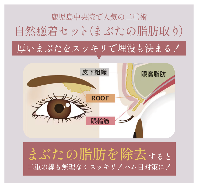 自然癒着セット