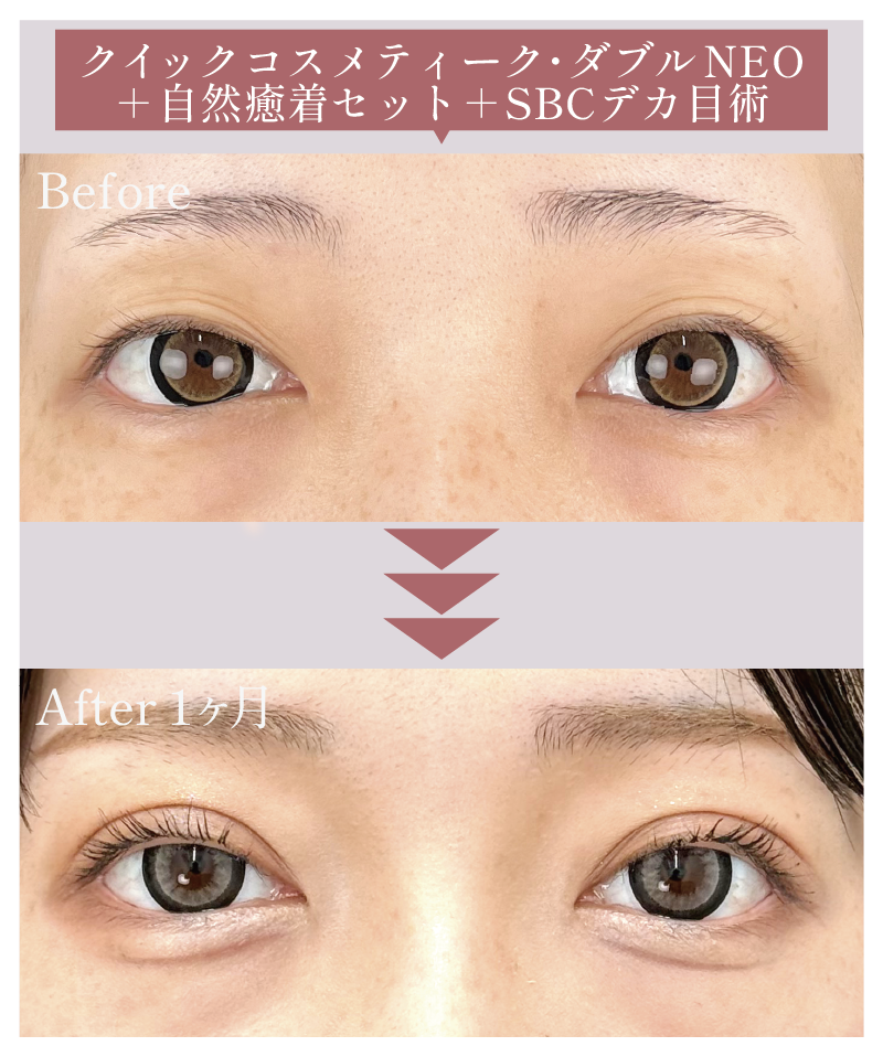 【末広（広め）】クイックコスメティーク・ダブルNEO＋複合施術