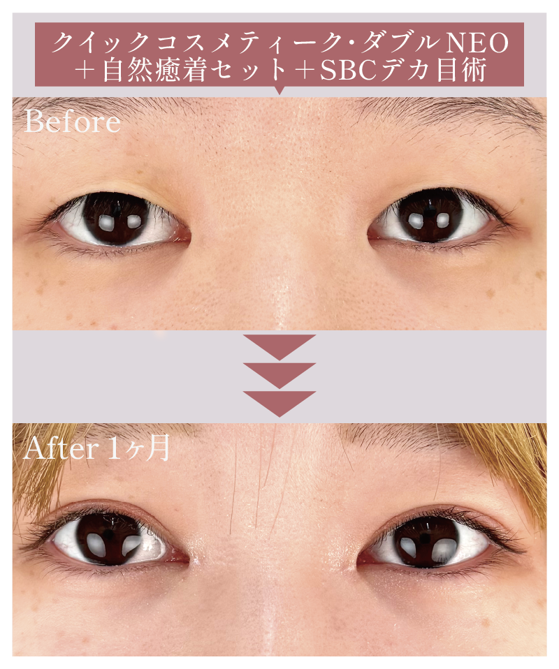 【末広（狭め）】クイックコスメティーク・ダブルNEO＋複合施術