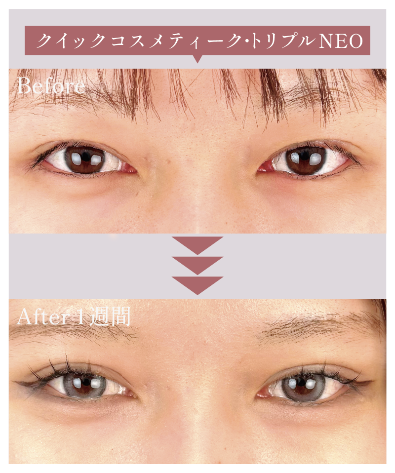 【MIX型】クイックコスメティーク・トリプルNEO