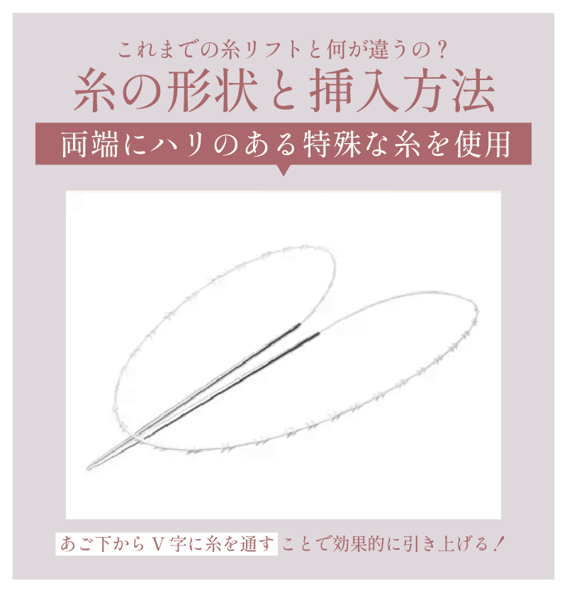 ズバリ！挿入方法