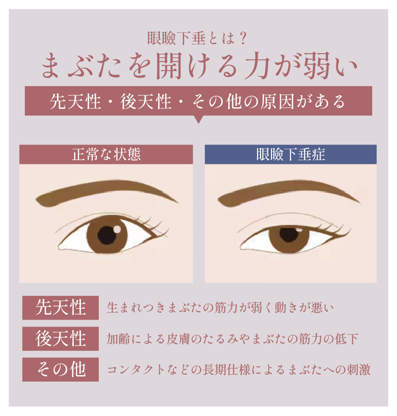 ”まぶたを開ける力が弱い”状態☝️