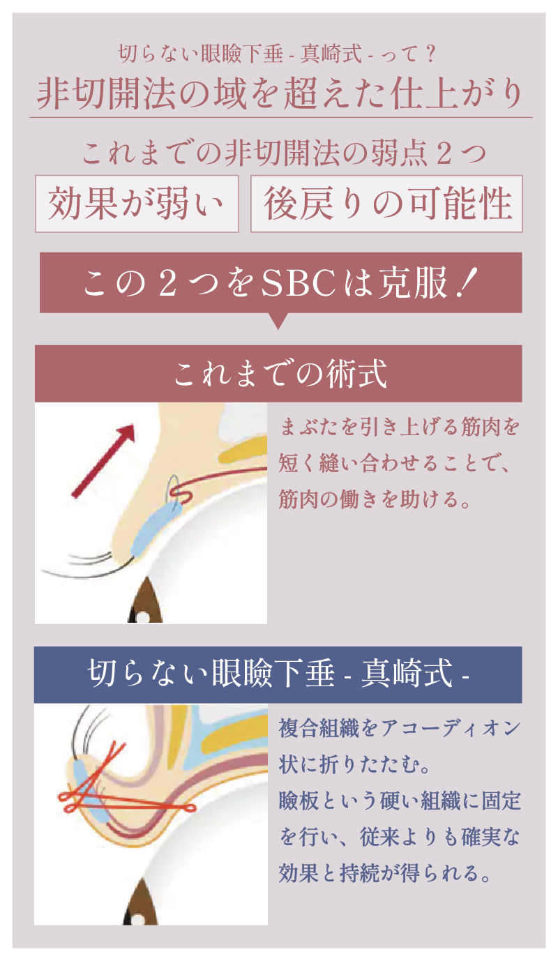 まぶたを切らずに目の開き・視野・見た目を改善！