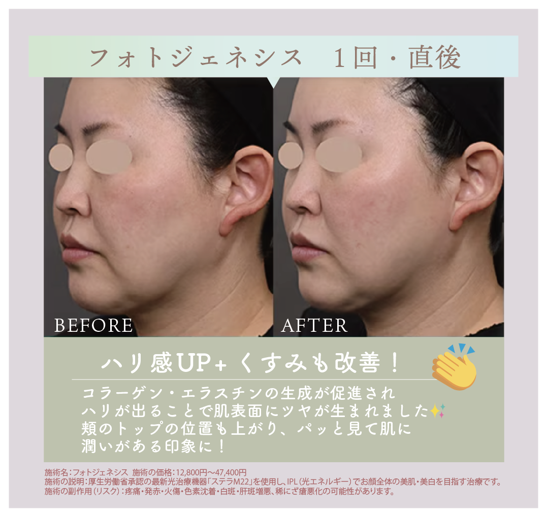 2回目1ヶ月後<br />
