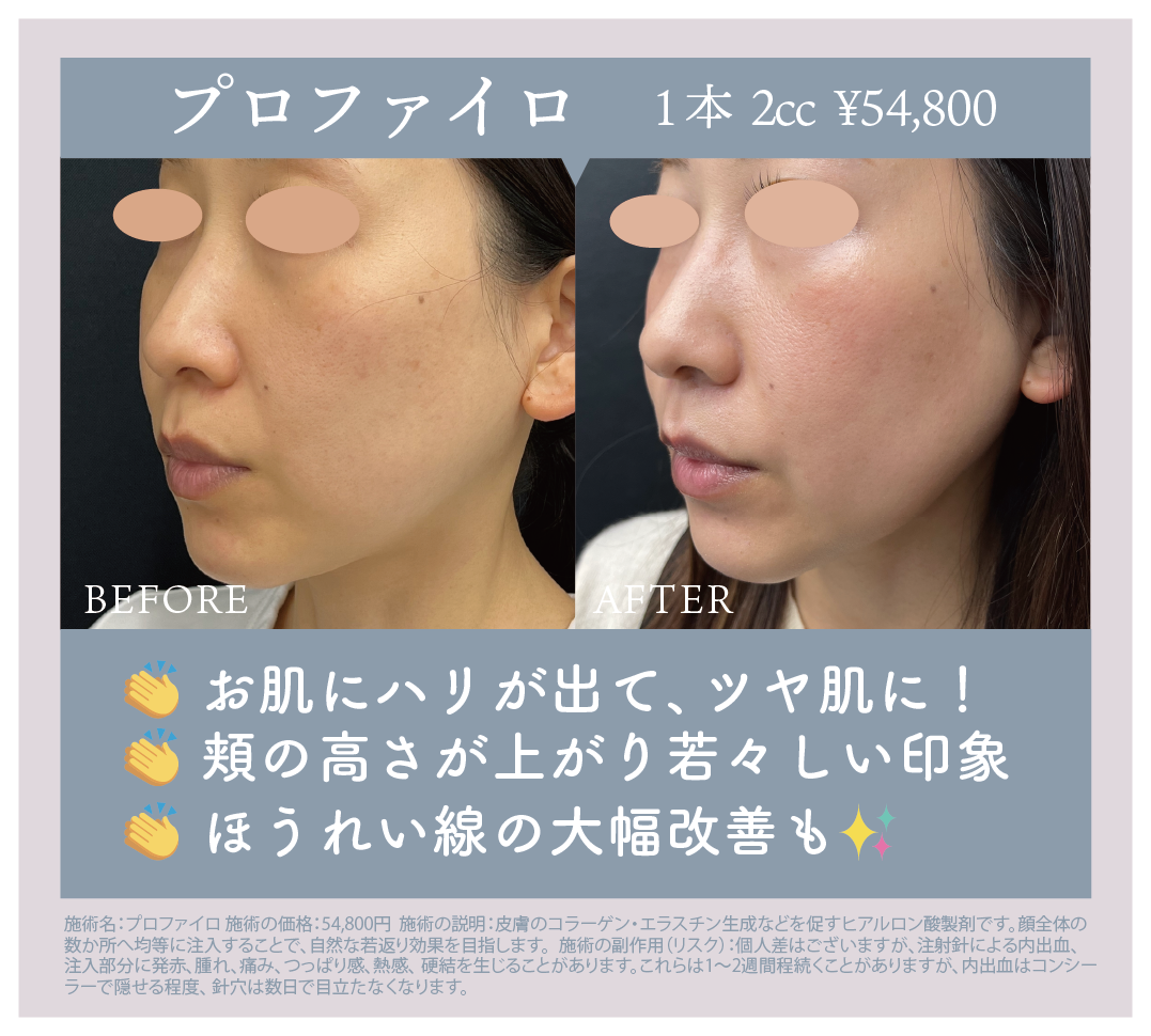 プロファイロ