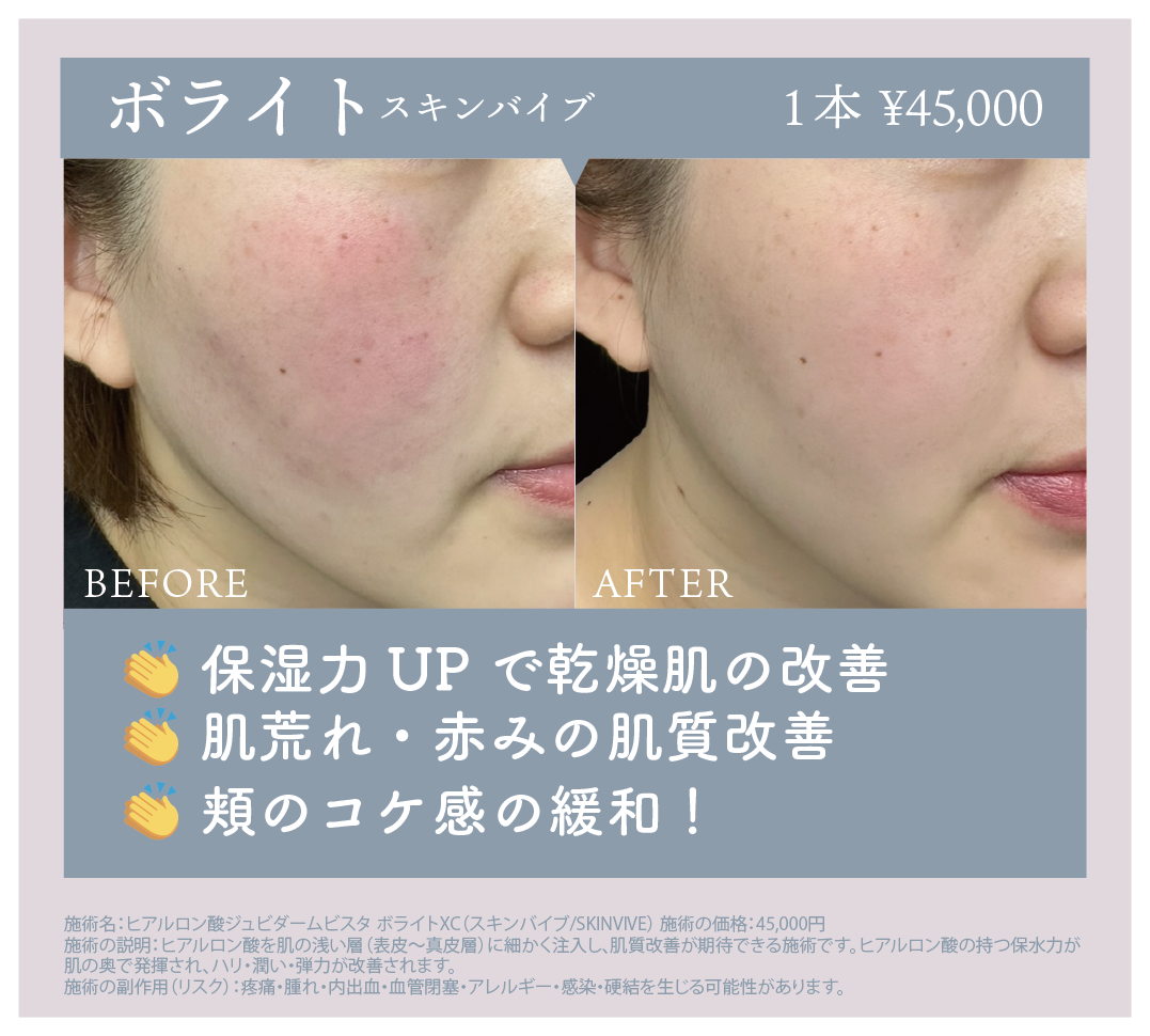 ボライト スキンバイブ