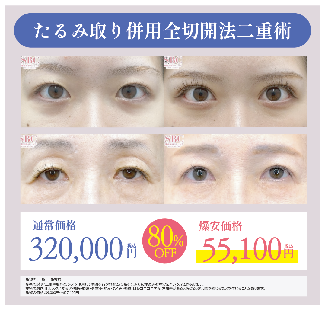 まぶたのたるんだ皮膚を除去＋二重形成