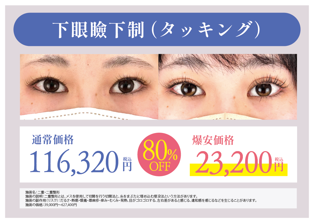 糸を使った切らないタレ目術