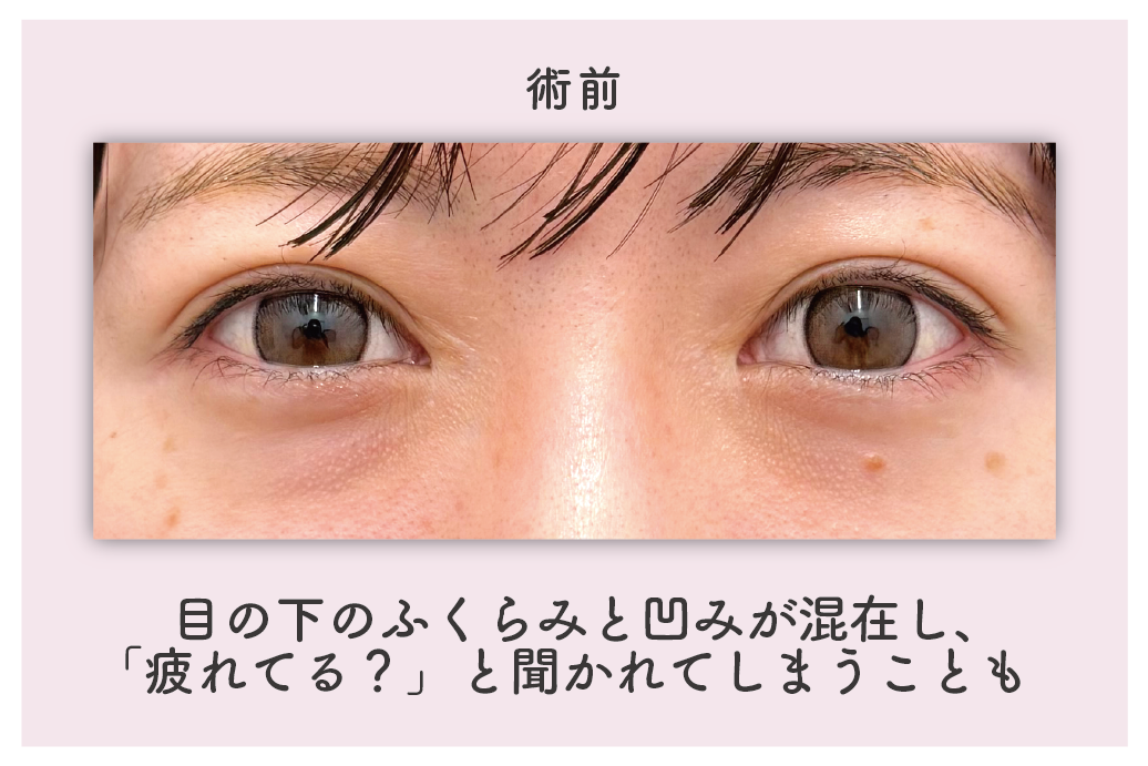 術前のお目元