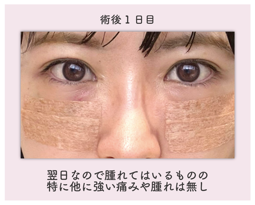 ダウンタイム：1日目