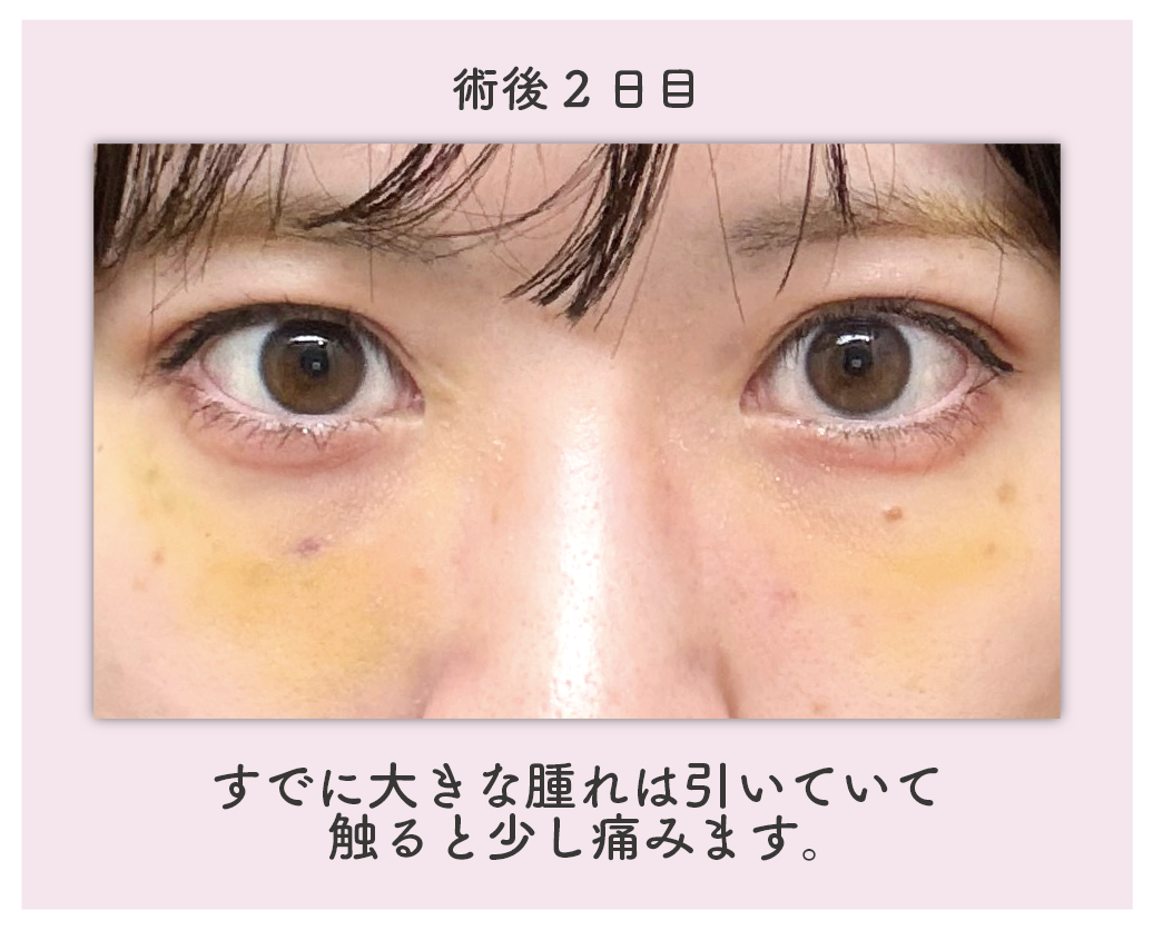 ダウンタイム：2日目