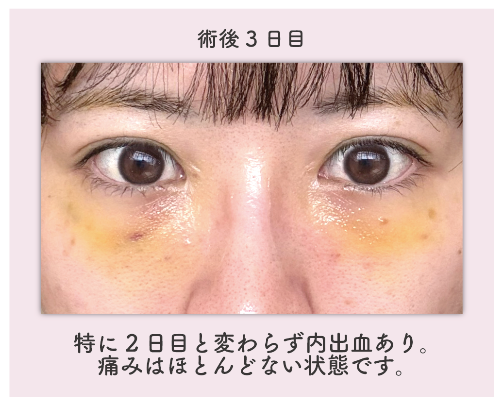 ダウンタイム：3日目