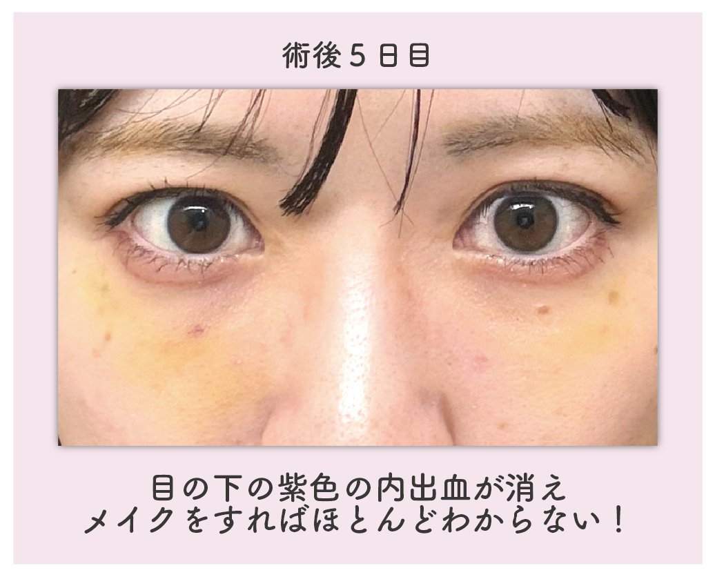 ダウンタイム：5日目