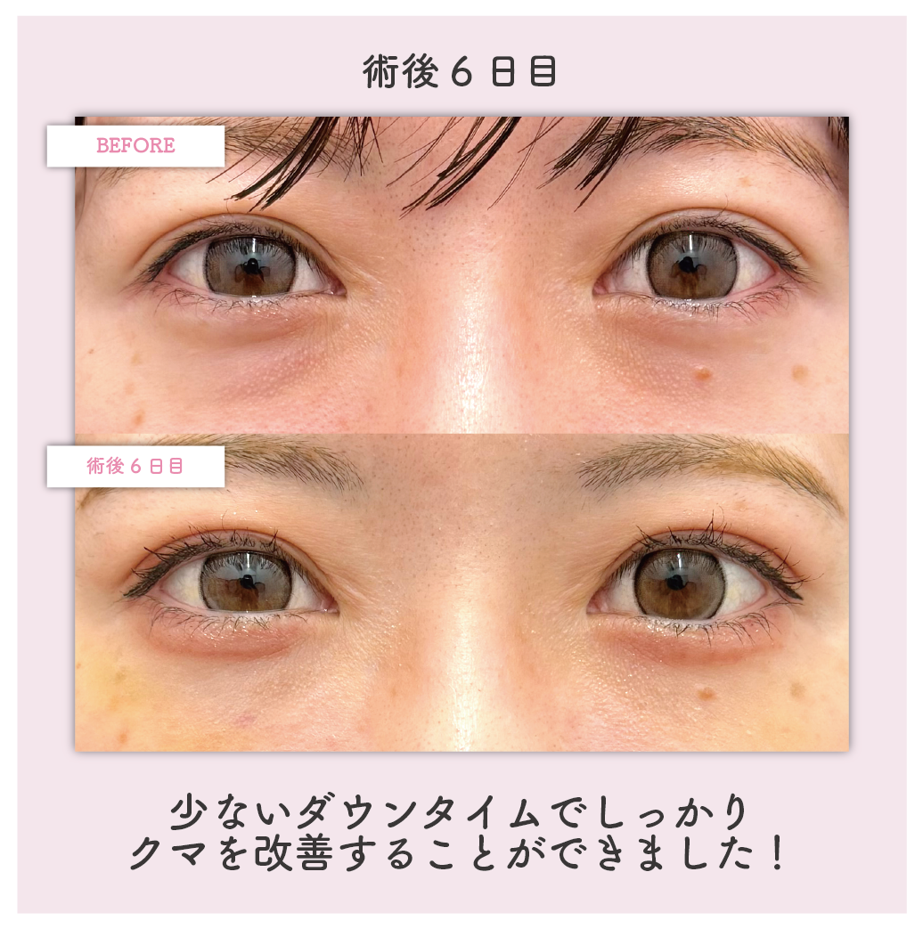 ダウンタイム：6日目