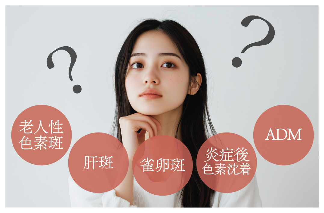 シミの種類は大きく分けて５種類
