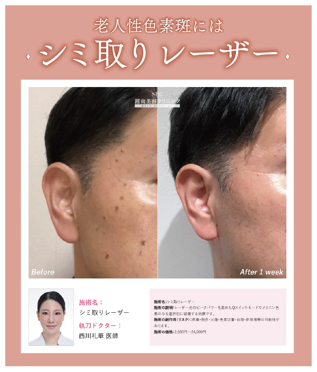 一般的な「シミ」男女問わずの「老人性色素斑」に効果的