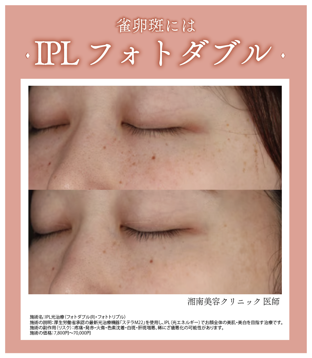 全体的なトーンアップならフォトダブル