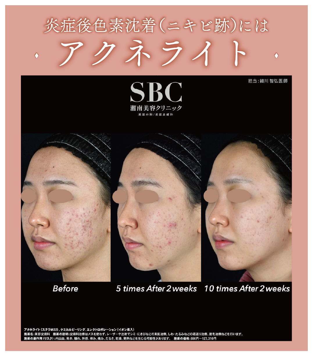 お悩みが多いのは「ニキビ跡」赤や茶色・黒の色素沈着に「アクネライト」