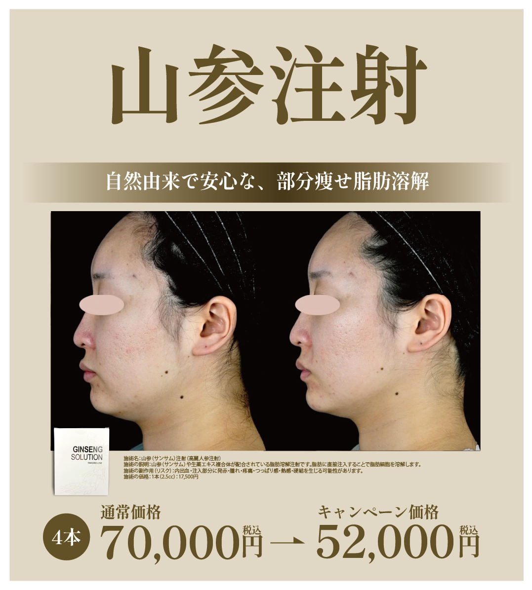 脂肪溶解注射  山参注射