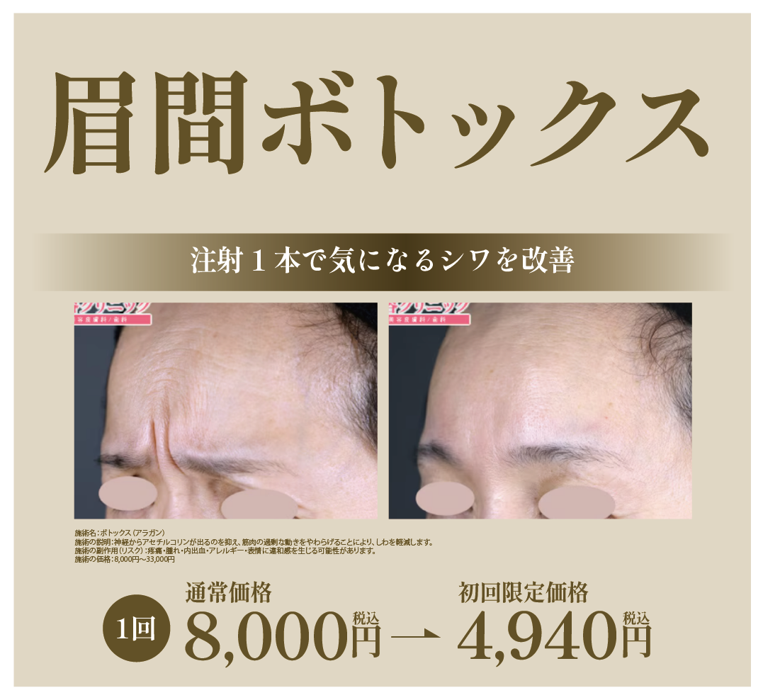 眉間ボトックス-アラガン製-
