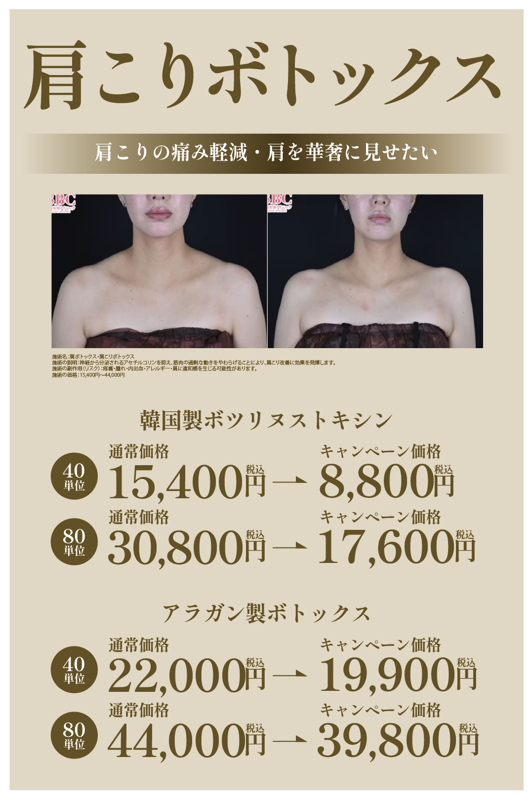 肩ボトックス