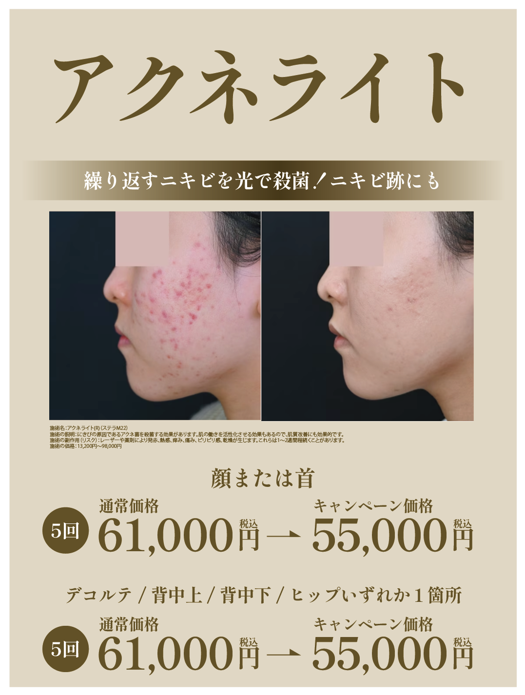 アクネライト
