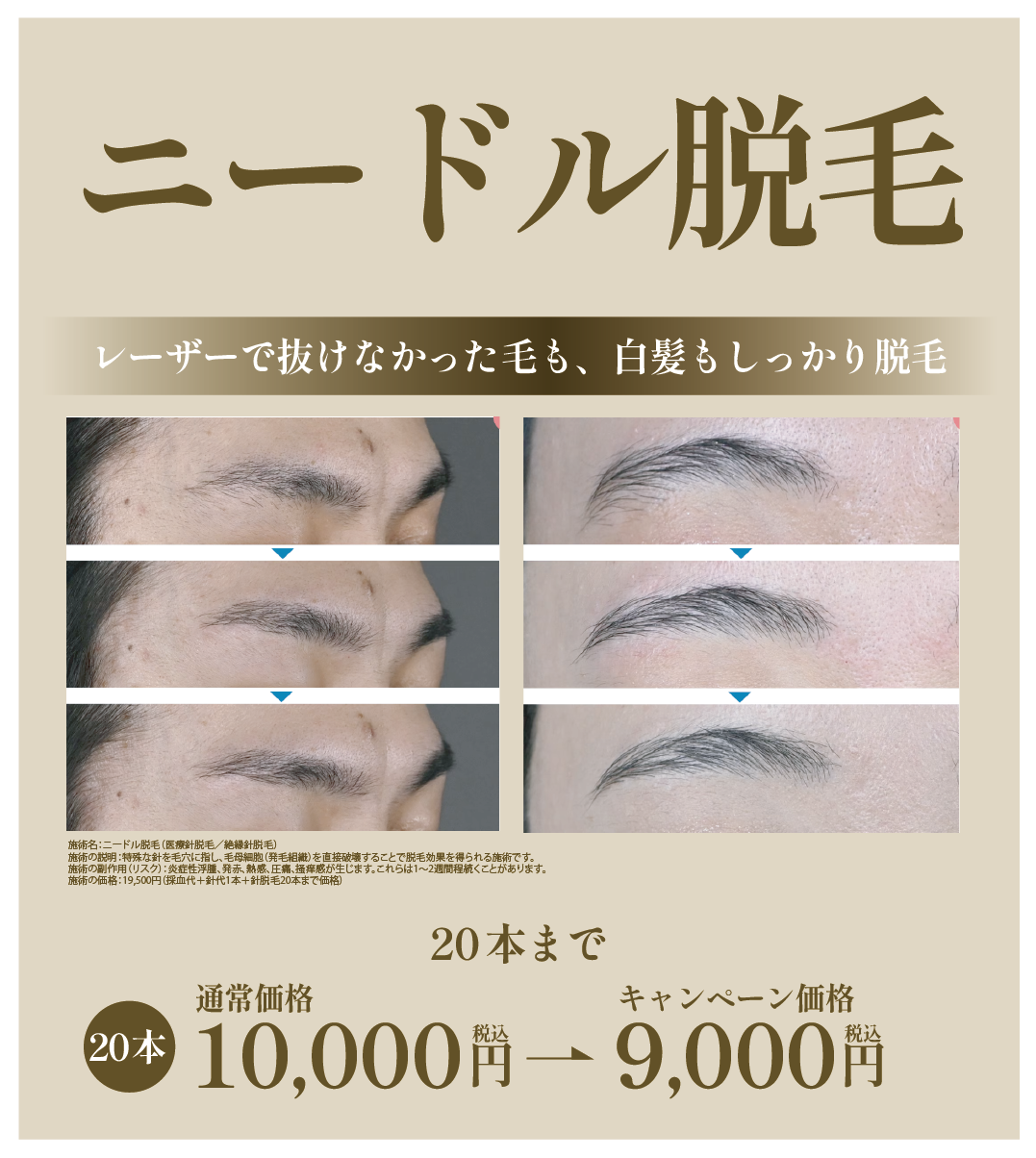 ニードル脱毛