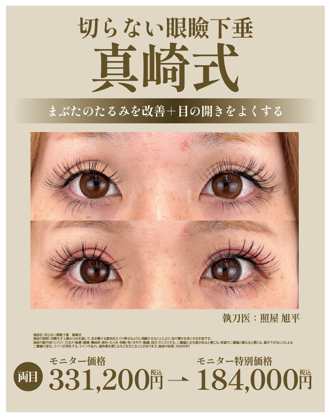 切らない眼瞼下垂”真崎式”