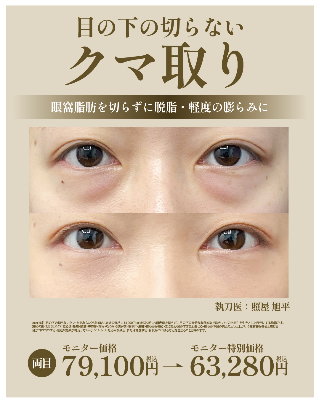 目の下の切らないクマ取り